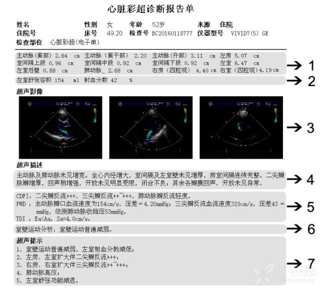 【转】手把手教你解读超声心动图报告单