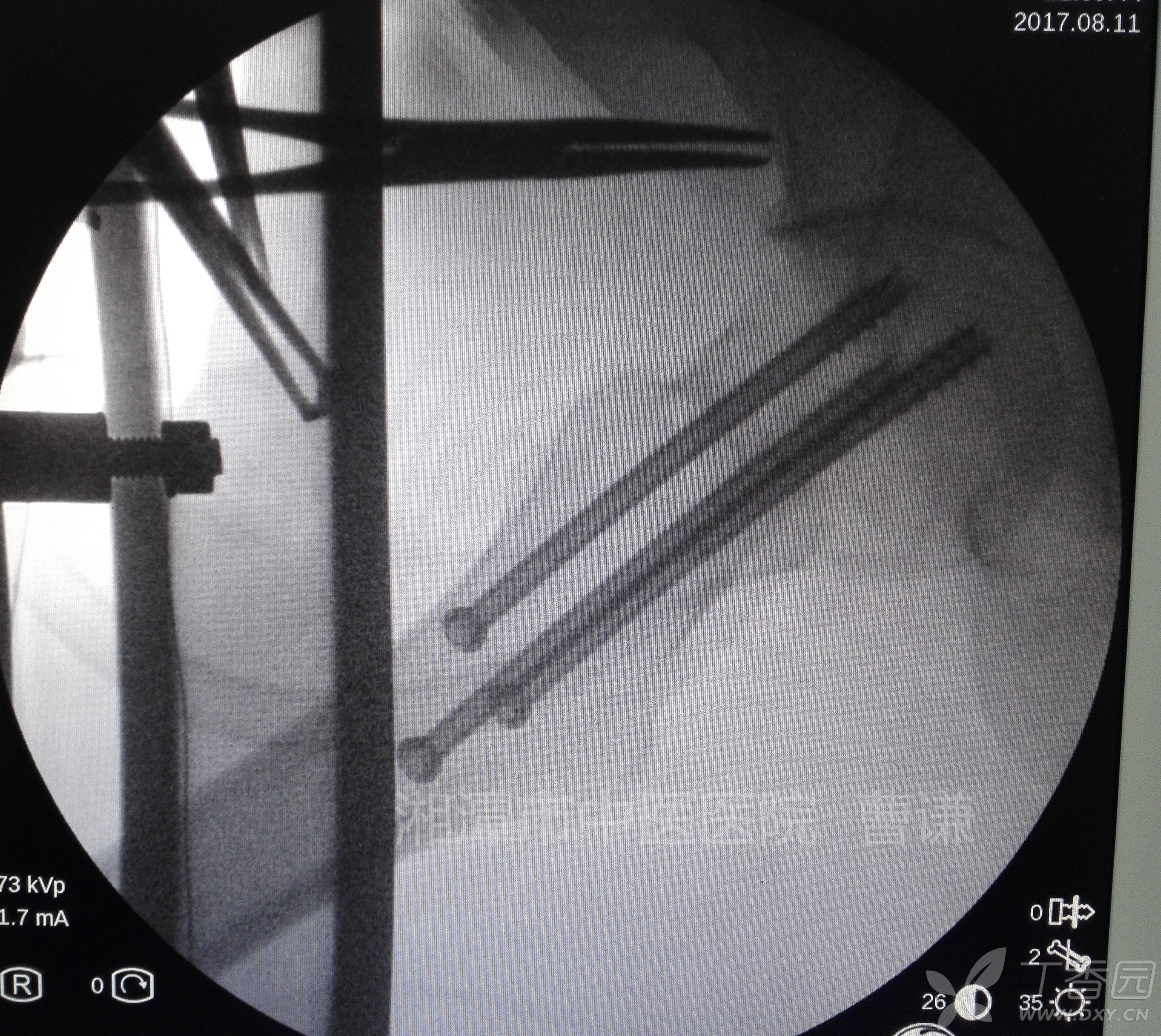 股骨颈骨折闭合复位空心钉内固定术[病例帖]