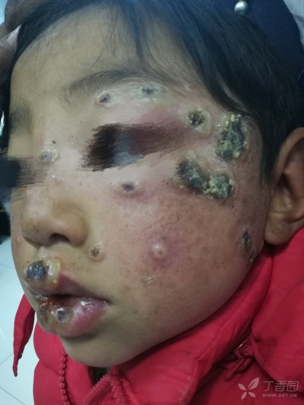 女,4岁,面部及双耳廓疱疹3天