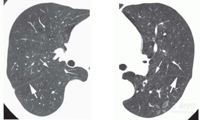 fig.8 叶间裂