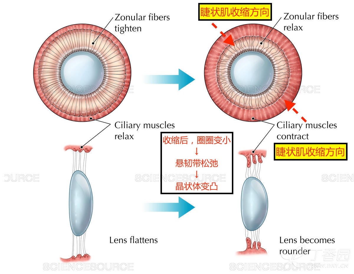 通俗易懂解释睫状肌收缩时,悬韧带松弛,晶状体变凸(图解)