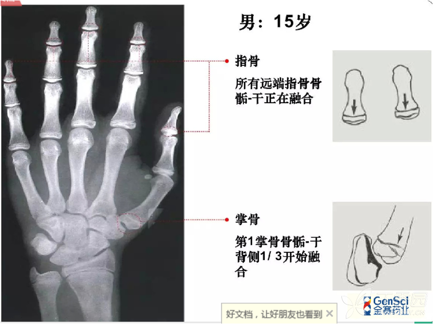 骨龄,请同行们看看,我儿子的,看看骨龄有几岁.谢谢