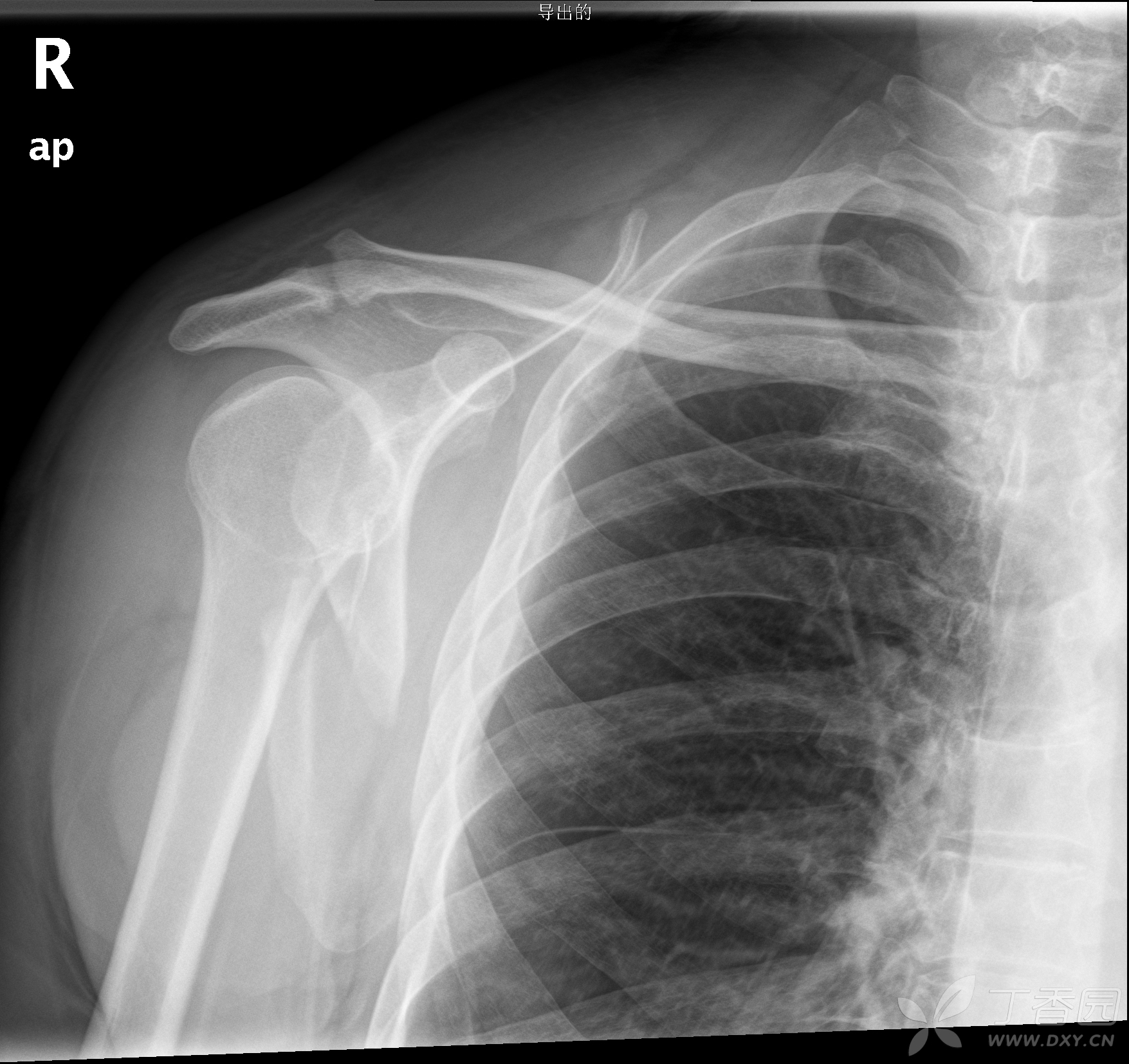 查体触及锁骨区骨擦感,肩胸触痛显著,传导痛+ 首次摄片