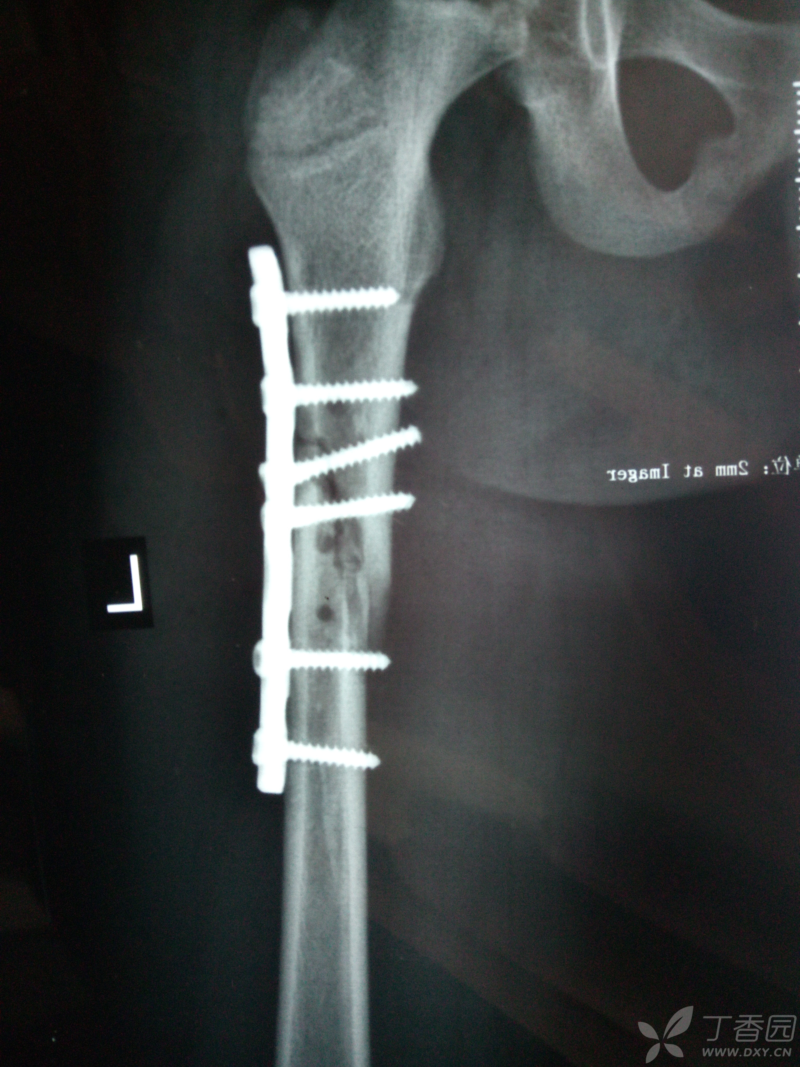 9岁儿童股骨中上段骨折钢板内固定术后是否需要髋人字石膏固定 [病例