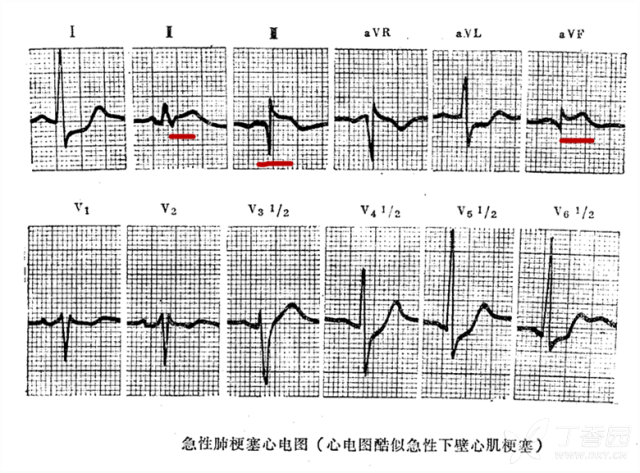 肺栓塞的心电图诊断