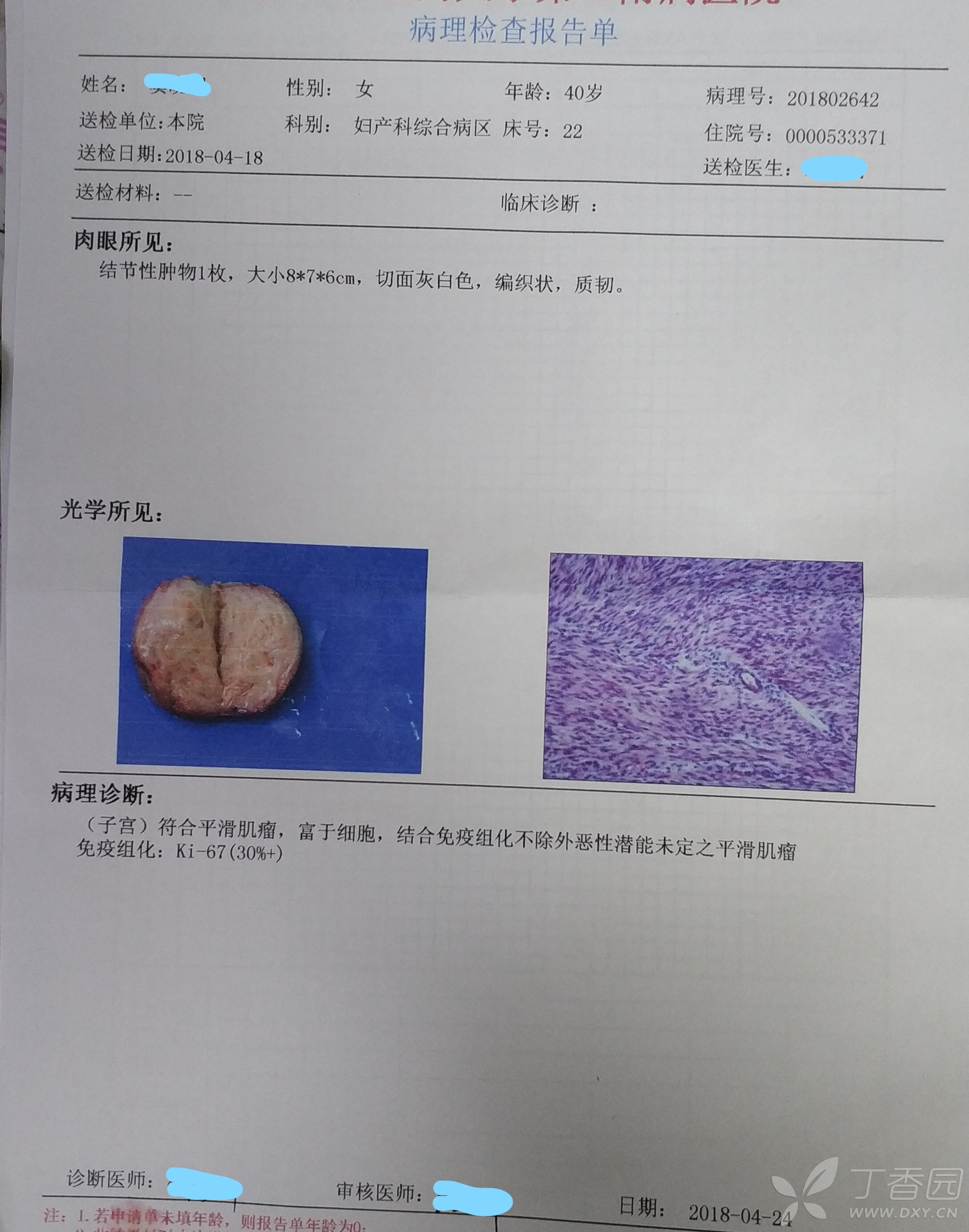 但病理诊断为" (子宫)符合平滑肌瘤,富于细胞,结合免疫组化不除外恶性