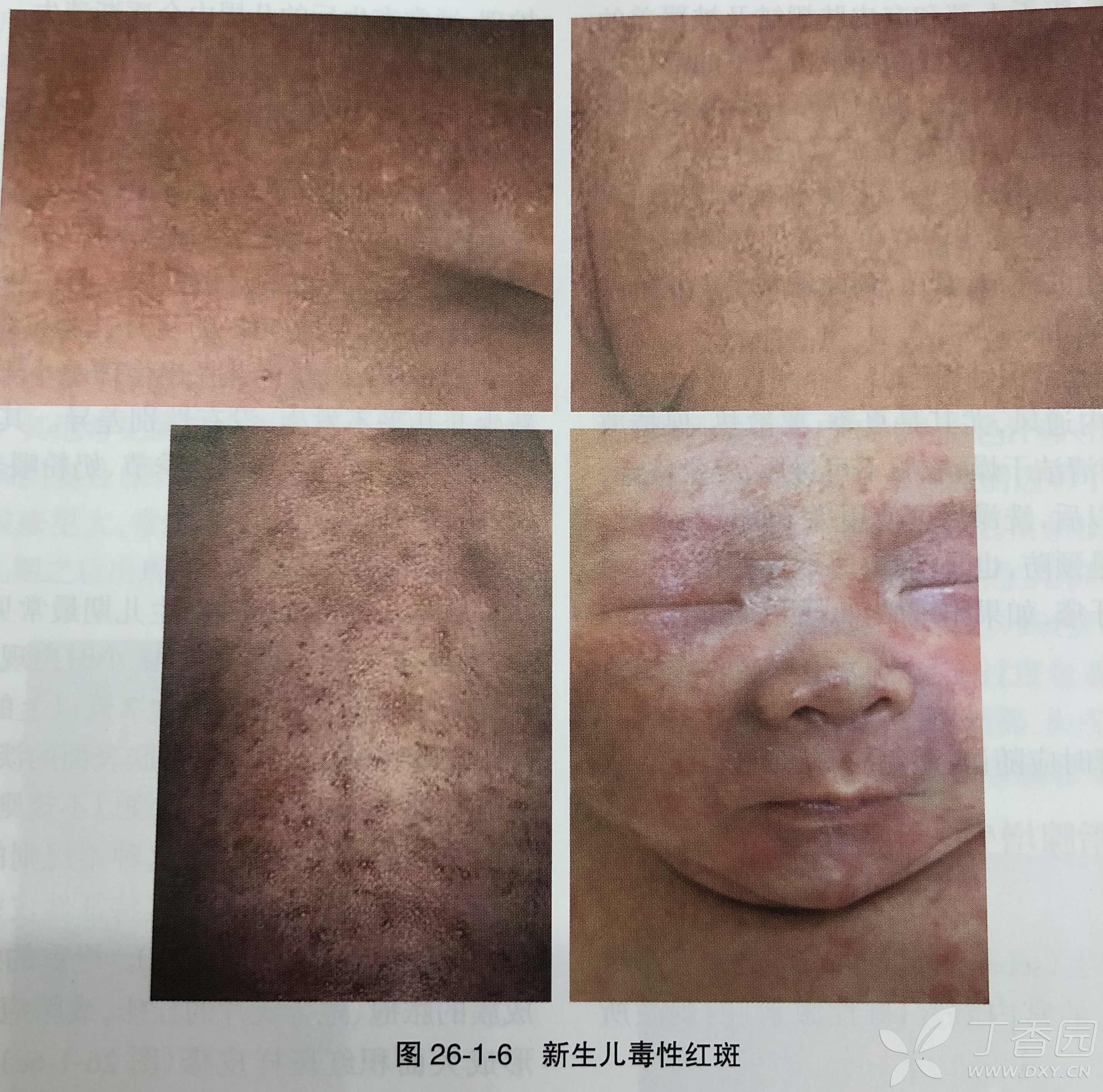 相关疾病: 痱子 血管瘤 婴儿痤疮 新生儿中毒性红斑 皮脂腺增生 最近