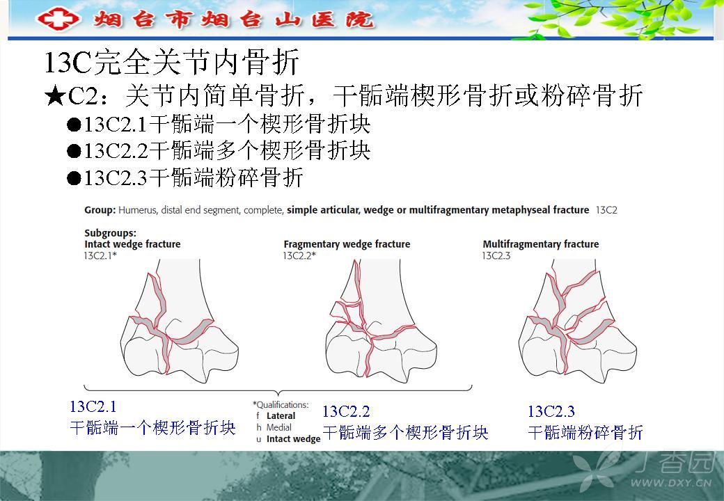 肱骨远端c型骨折的手术入路--规范与创新