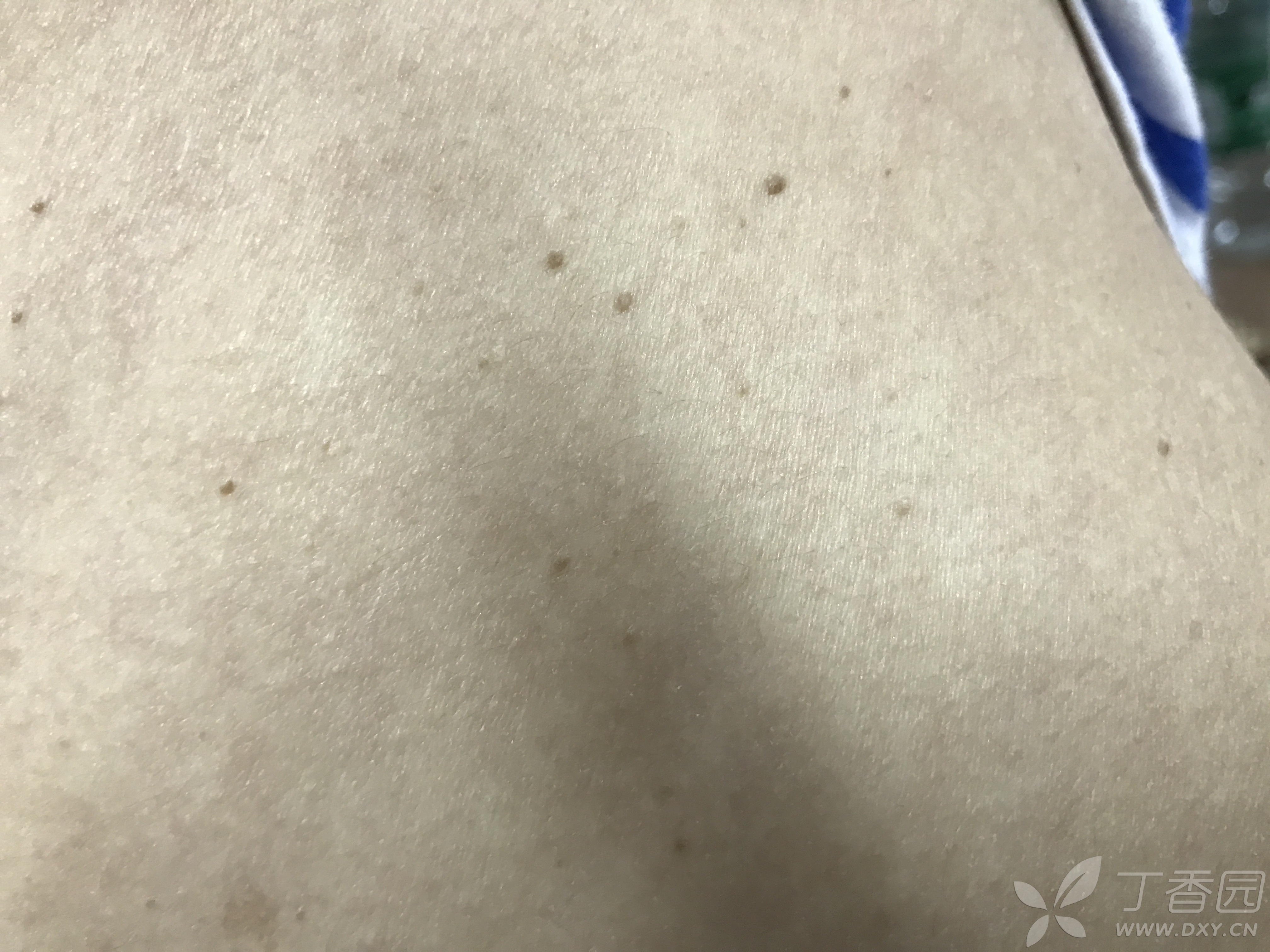 脂溢性角化?还是别的什么?