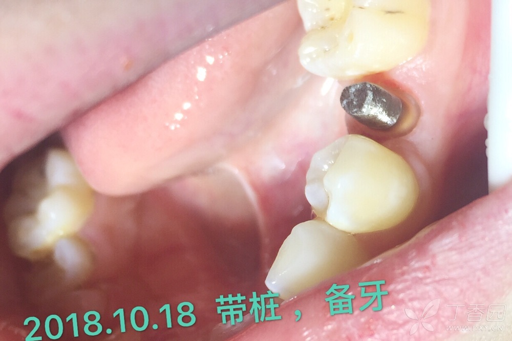 × 查看 可能涉及到敏感图片,点击后可查看 纤维桩虽然更符合牙本质