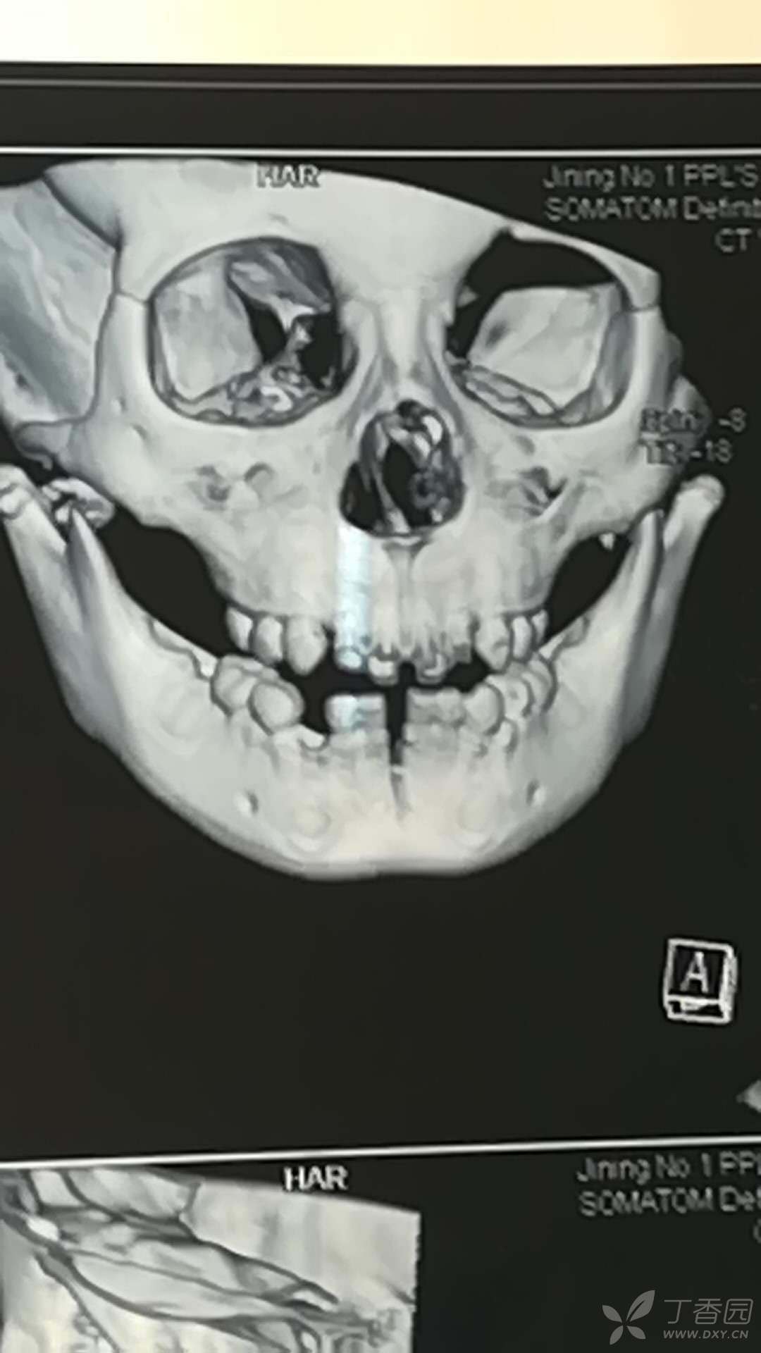 双侧髁突粉碎性骨折 下颌骨骨体骨折