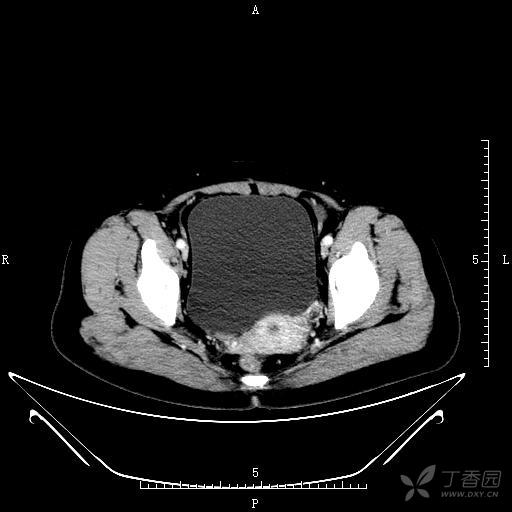 盆腔ct 