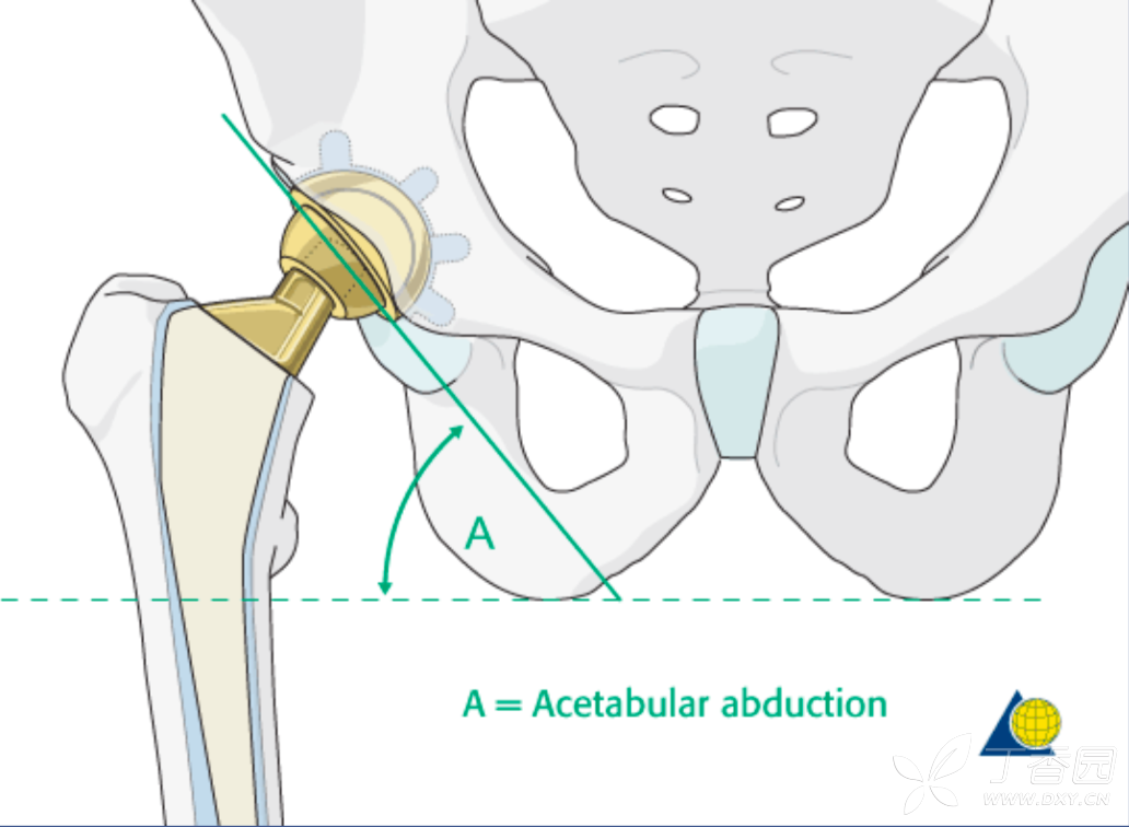 髋臼假体的前倾角和外展角--美图2张