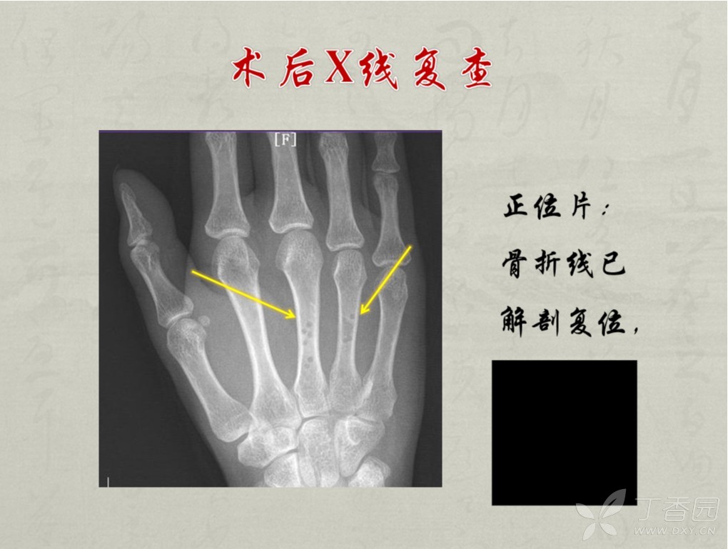 掌骨骨折可吸收螺钉固定 [病例帖]