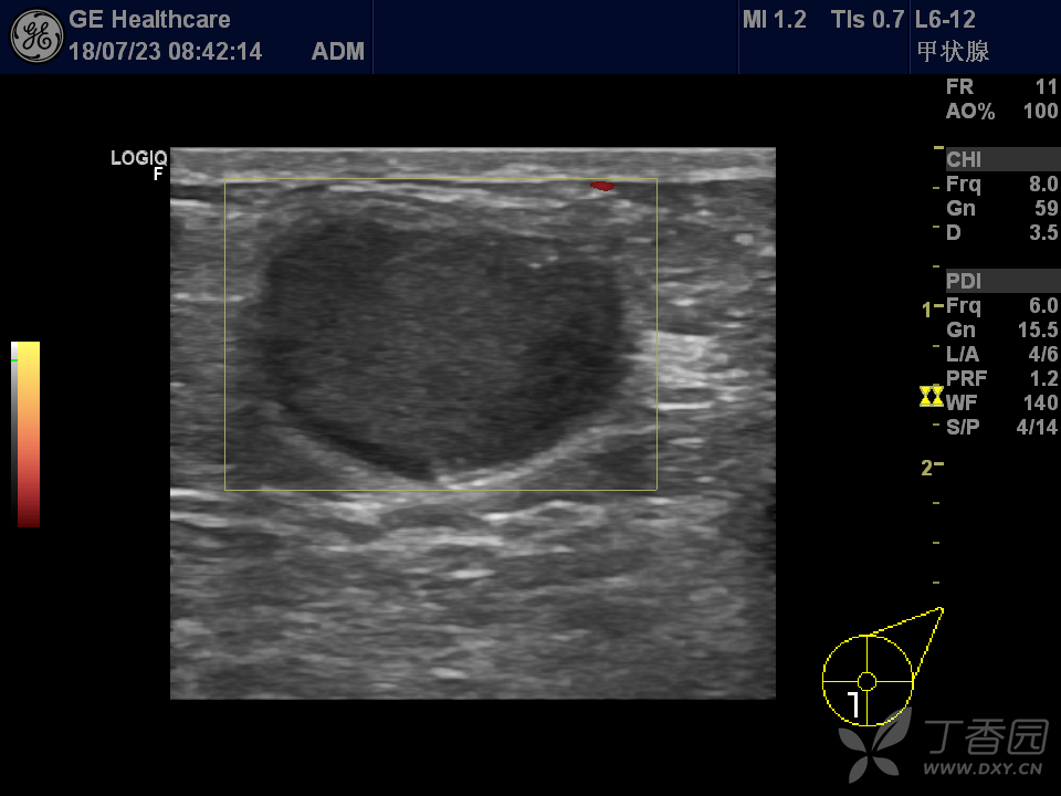 乳腺纤维腺瘤 - 超声医学讨论版 -丁香园论坛