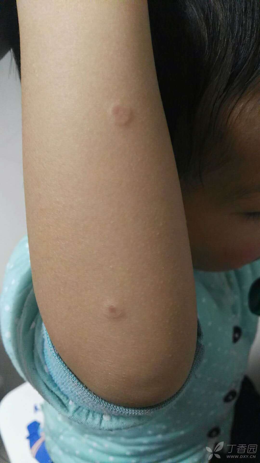 儿童圆形丘疹,中间有凹陷,无瘙痒