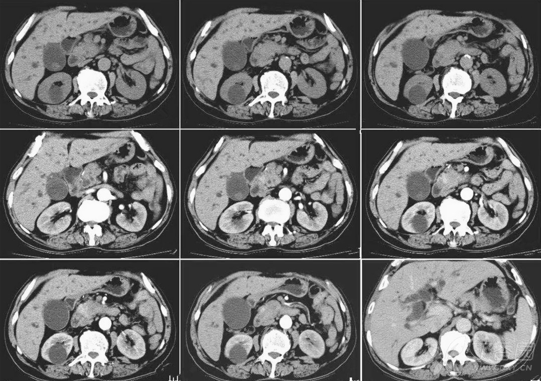 3,双管症 4,于周围组织分界不清 影像学表现ct:1,胰腺局限性增大,肿块