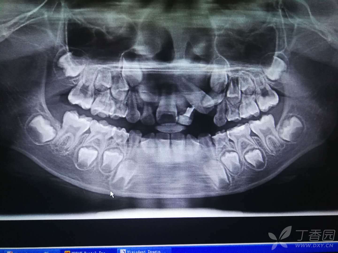 7岁儿童牙齿问题,求助大神