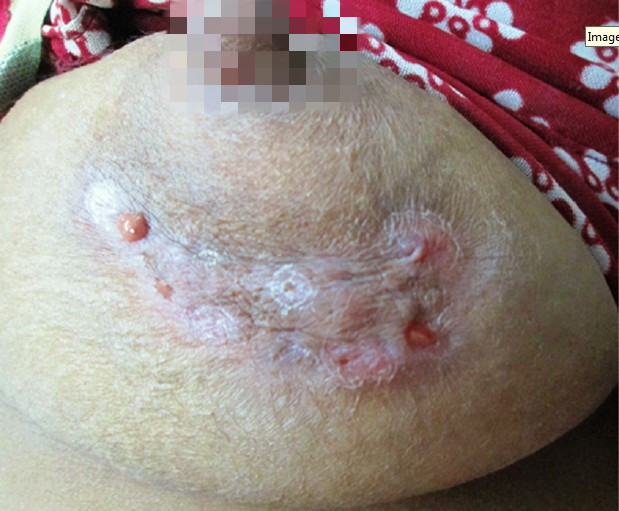 一例 41 岁男性右口角无症状性疣状结节伴结痂(图片来源:swali r