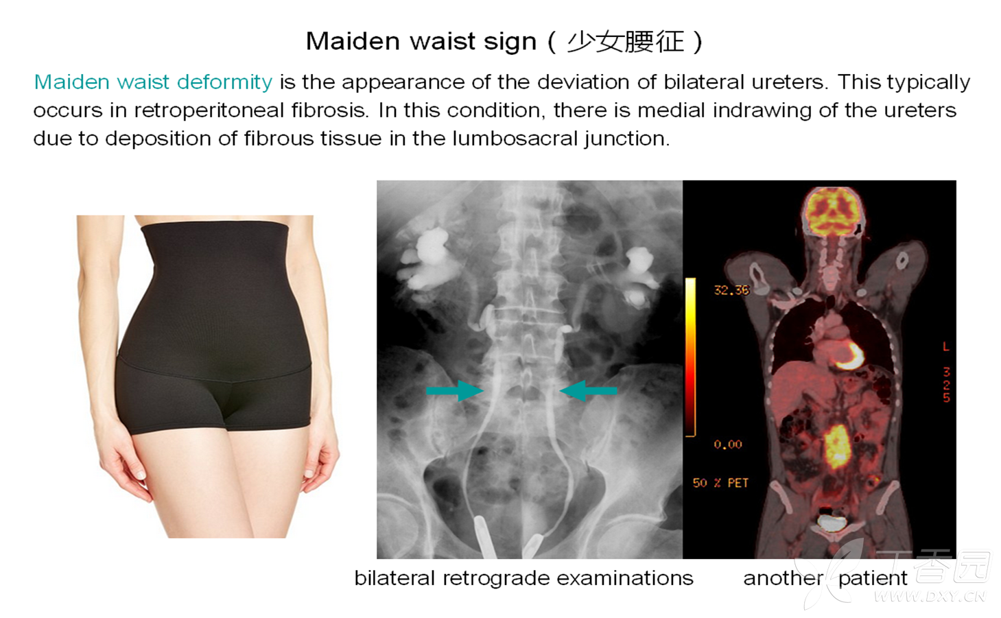 maiden waist sign(少女腰征) [病例帖]