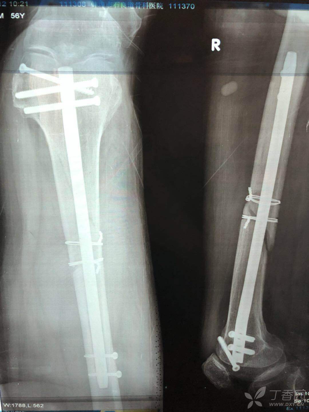 车祸导致大腿股骨中断骨折，动过两次手术，愈合不理想，怎么办？_百度知道