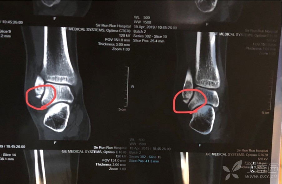 左腓骨外踝骨折图片大全 Uc今日头条新闻网