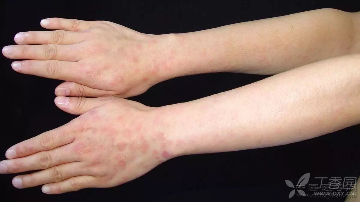 上肢外侧斑疹性二期梅毒疹
