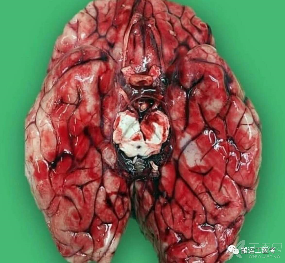 看完这篇,就会对蛛网膜下腔出血的病因,诊断,治疗,预后有了深刻的认识