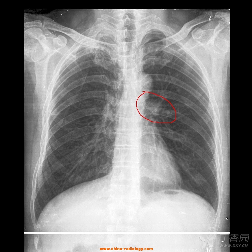 右上肺陈旧性结核,胸片体检;请问左肺门这看着自然吗?没有问题吧?