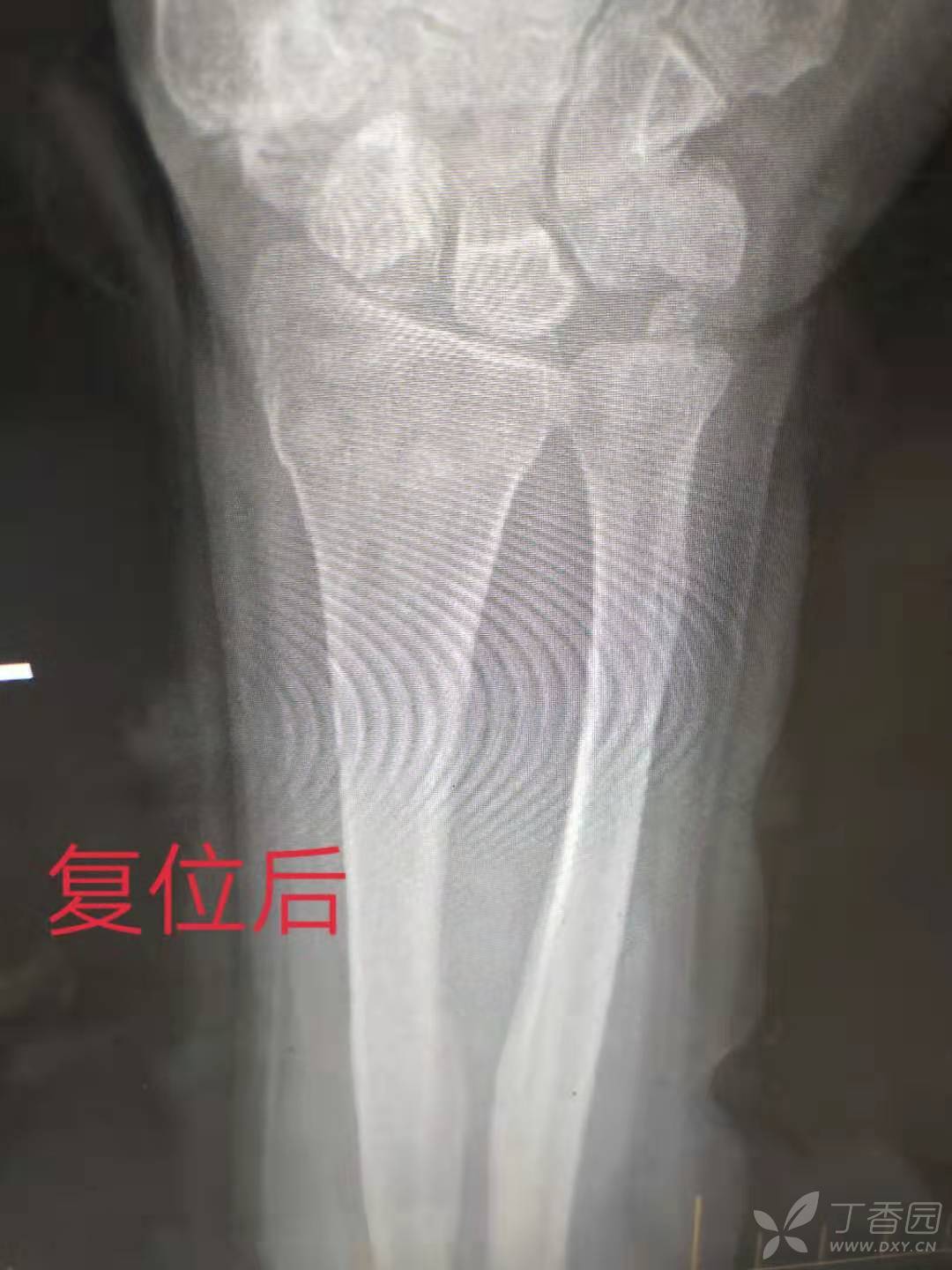 一例桡骨远端骨折,尺骨茎突骨折手法复位