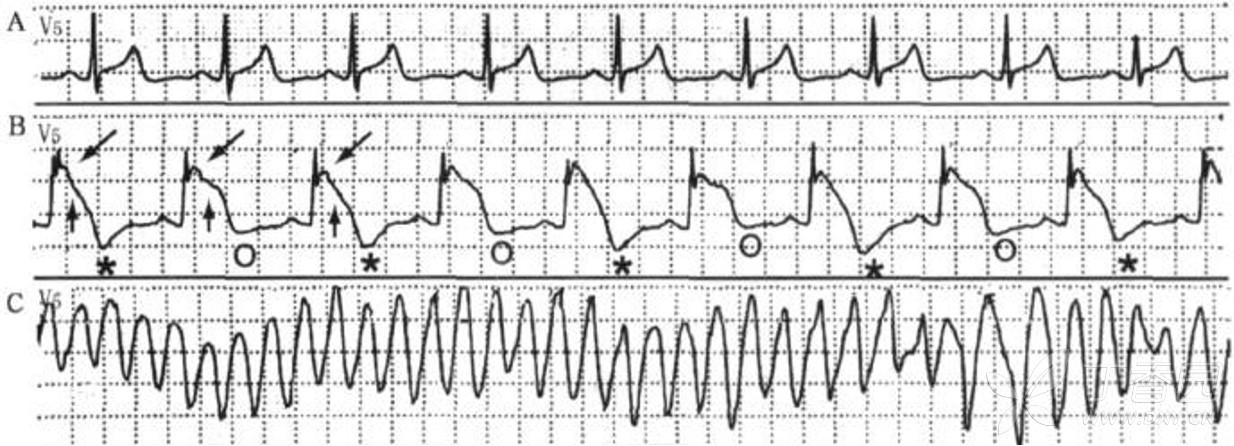 猝死预警心电图集锦(二)