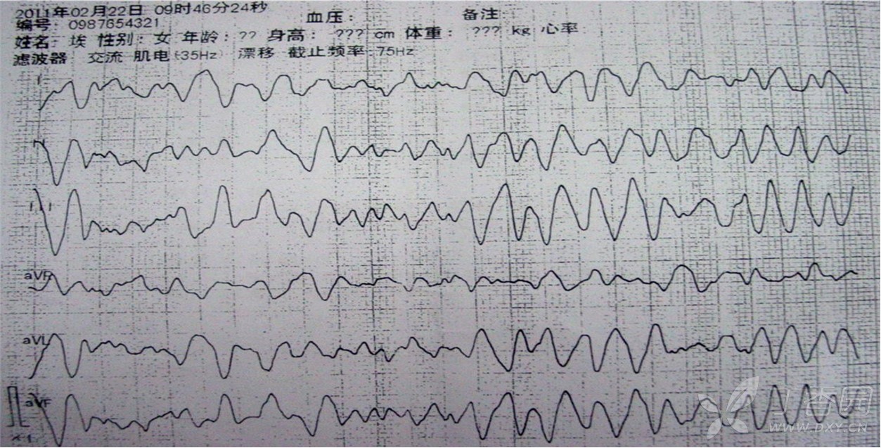 猝死预警心电图集锦(二)