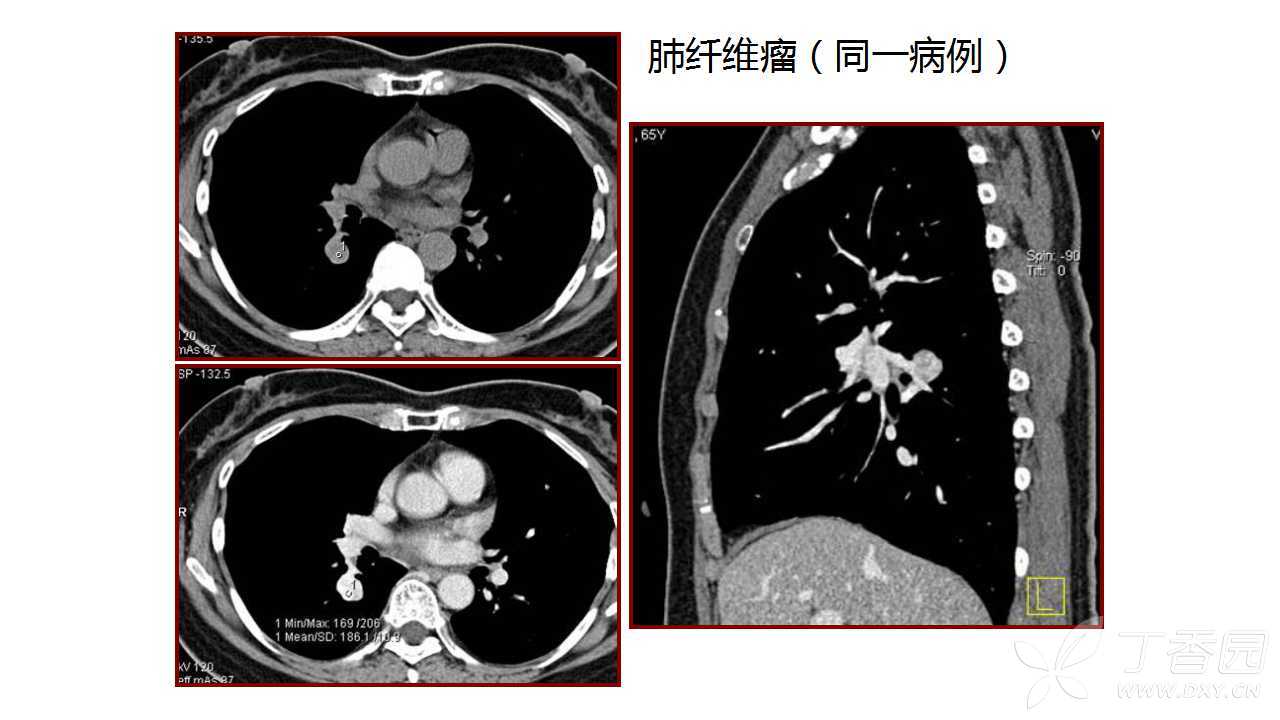 肺错构瘤的鉴别诊断