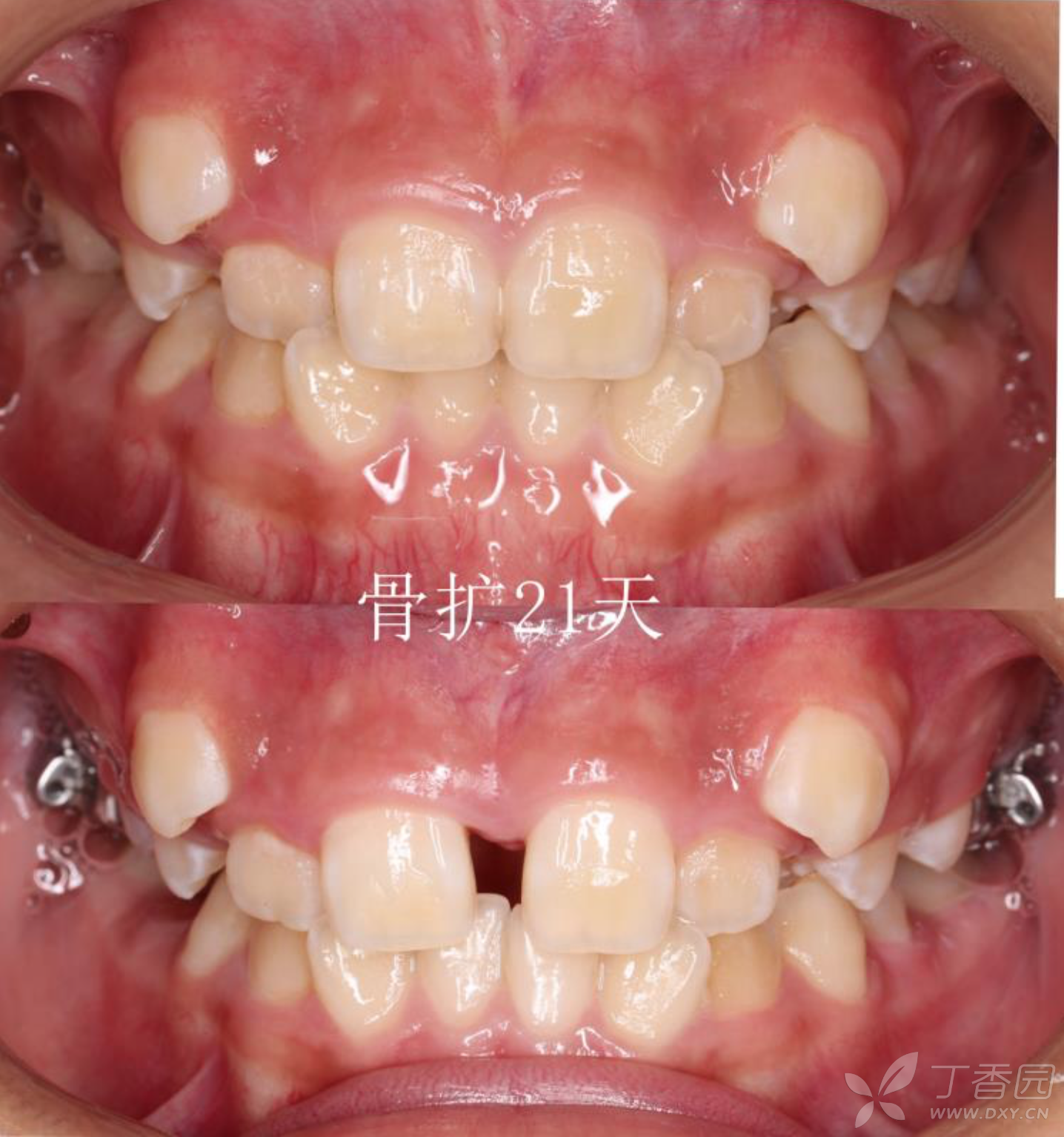 正畸临床病例(八)—"横向先行"扩弓的方法与技巧