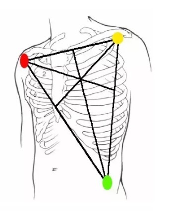 3 导联心电导线颜色标记为红,黄,绿或白,黑,红;5 导联心电导线颜色