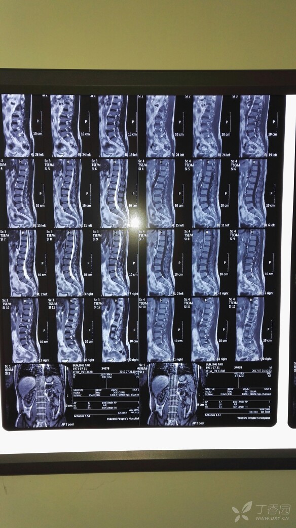 请教,是否是腰椎结核? [病例帖]