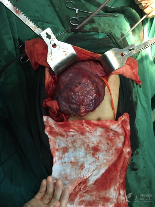 右肝癌自发破裂一例 [病例帖]