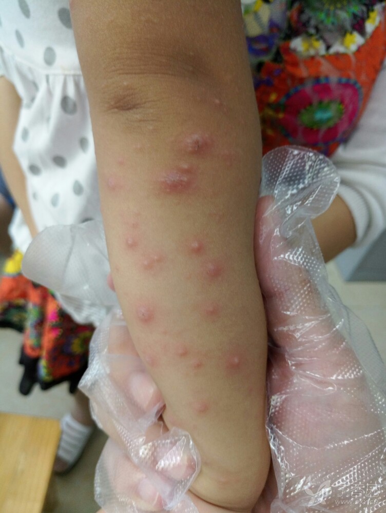 感染发炎的水痘图片图片