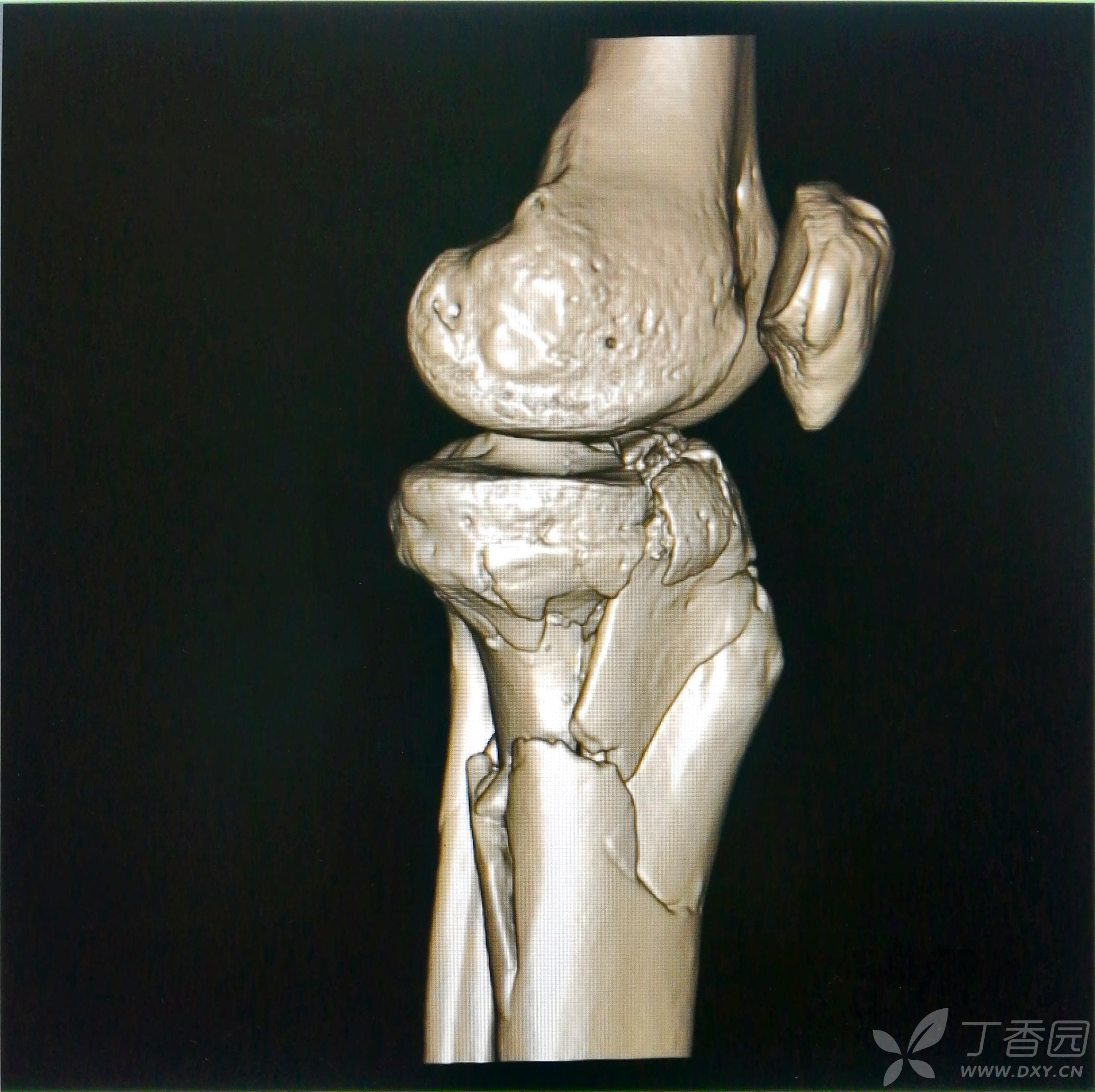 黄骨头胫骨平台骨折手术日记——双下肢多发粉碎性骨折一例——根据