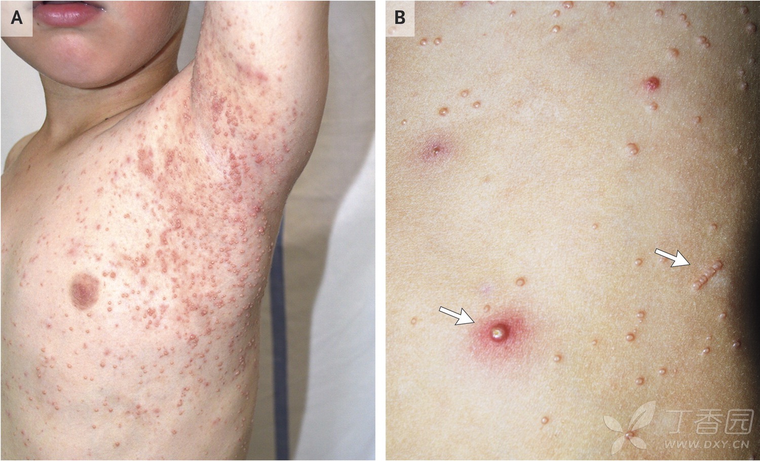 这个患儿的皮疹是什么病?