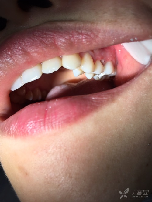 舌侧牙龈发白图片