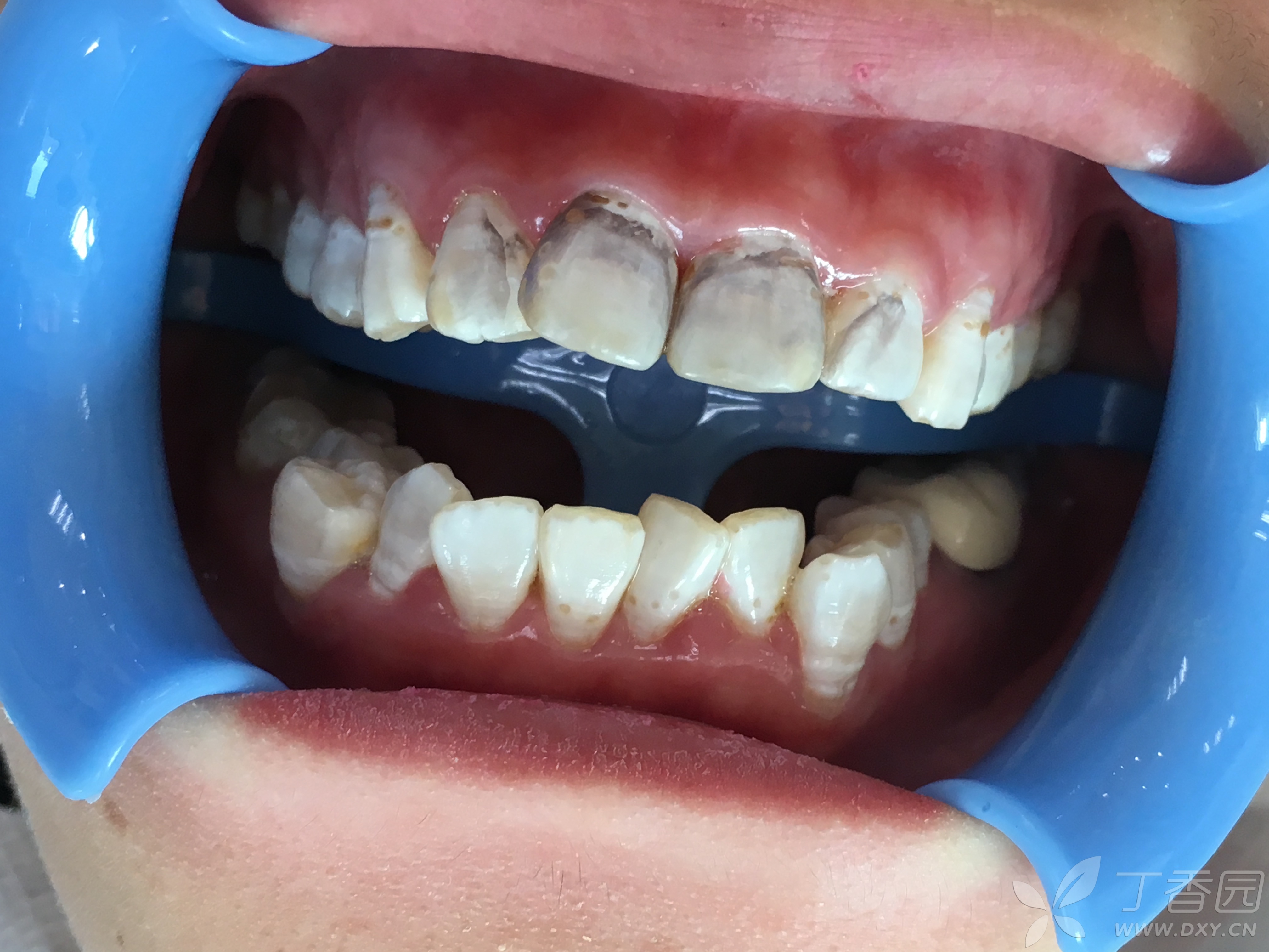 氟斑牙beyond冷光美白后,牙齿为什么会变黑,是去氟剂惹的祸嘛?