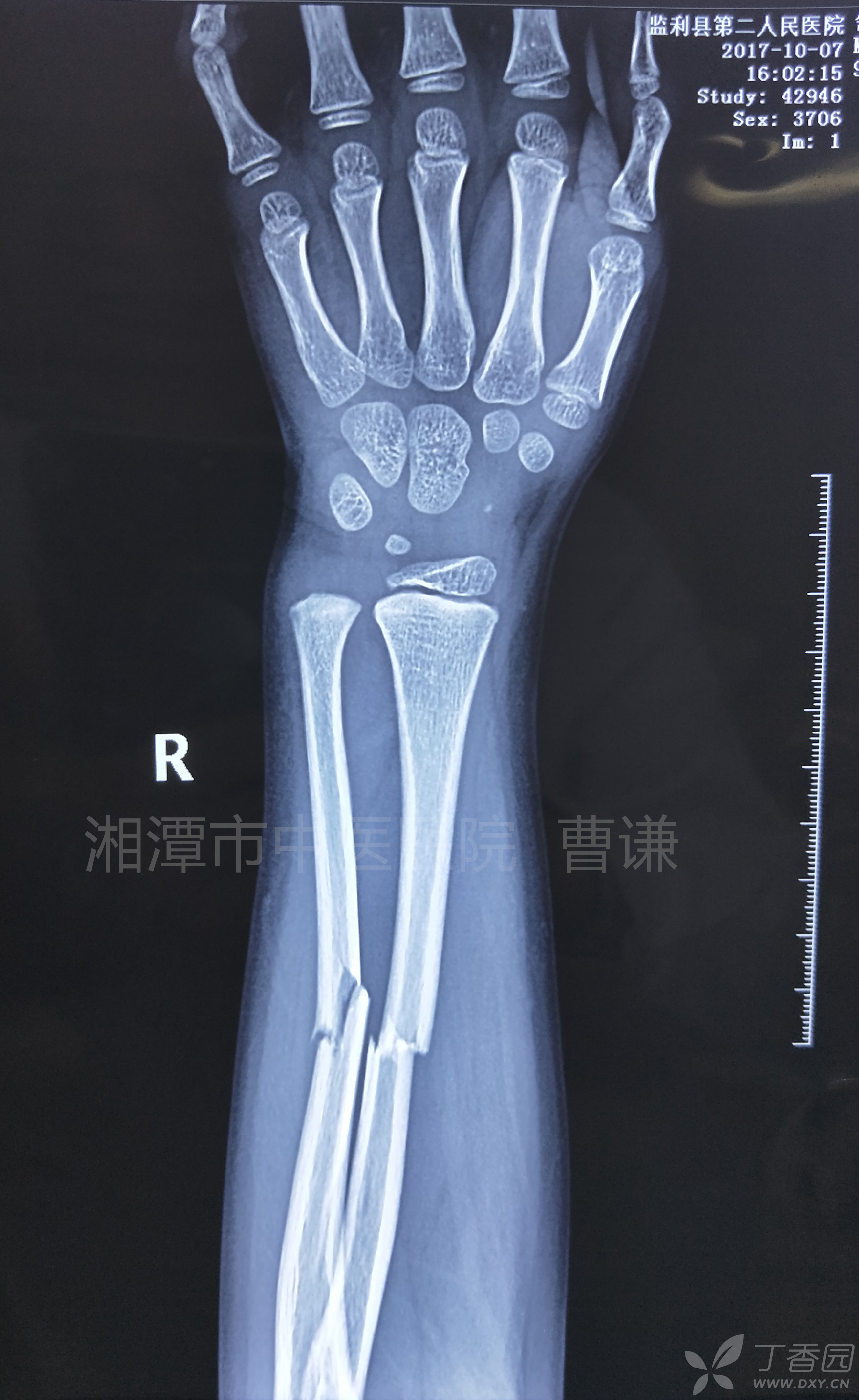 手臂尺骨骨折错位图片图片