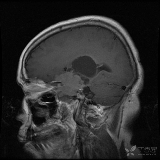 颅内占位，结果已公布 [病例帖]