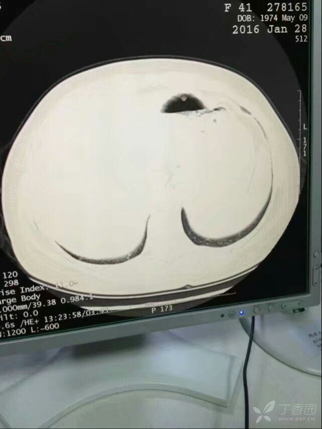 双肺多发磨玻璃结节,麻烦各位老师给解答解答