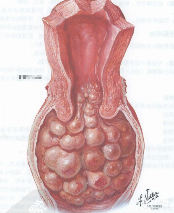 rous肉瘤病毒图片