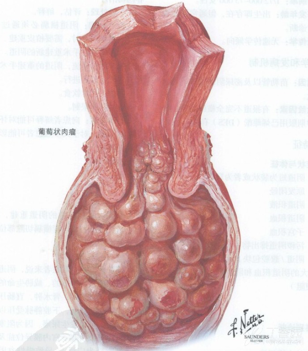 学图谱 答案公布:葡萄状肉瘤