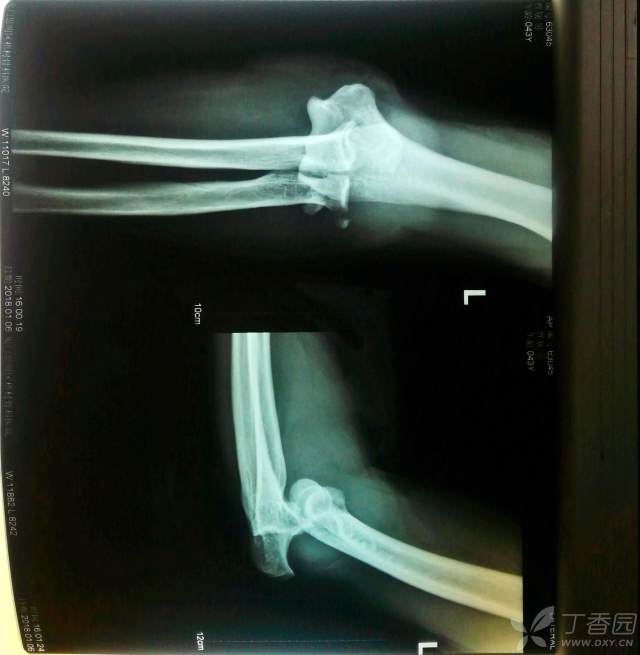 黄骨头肘关节骨折手术日记 肘关节恐怖三联征一例 手术已做 骨科专业讨论版 丁香园论坛 黄骨头肘关节骨折手术日记 肘关节恐怖三联征一例 手术已做 骨科专业讨论版 丁香园论坛