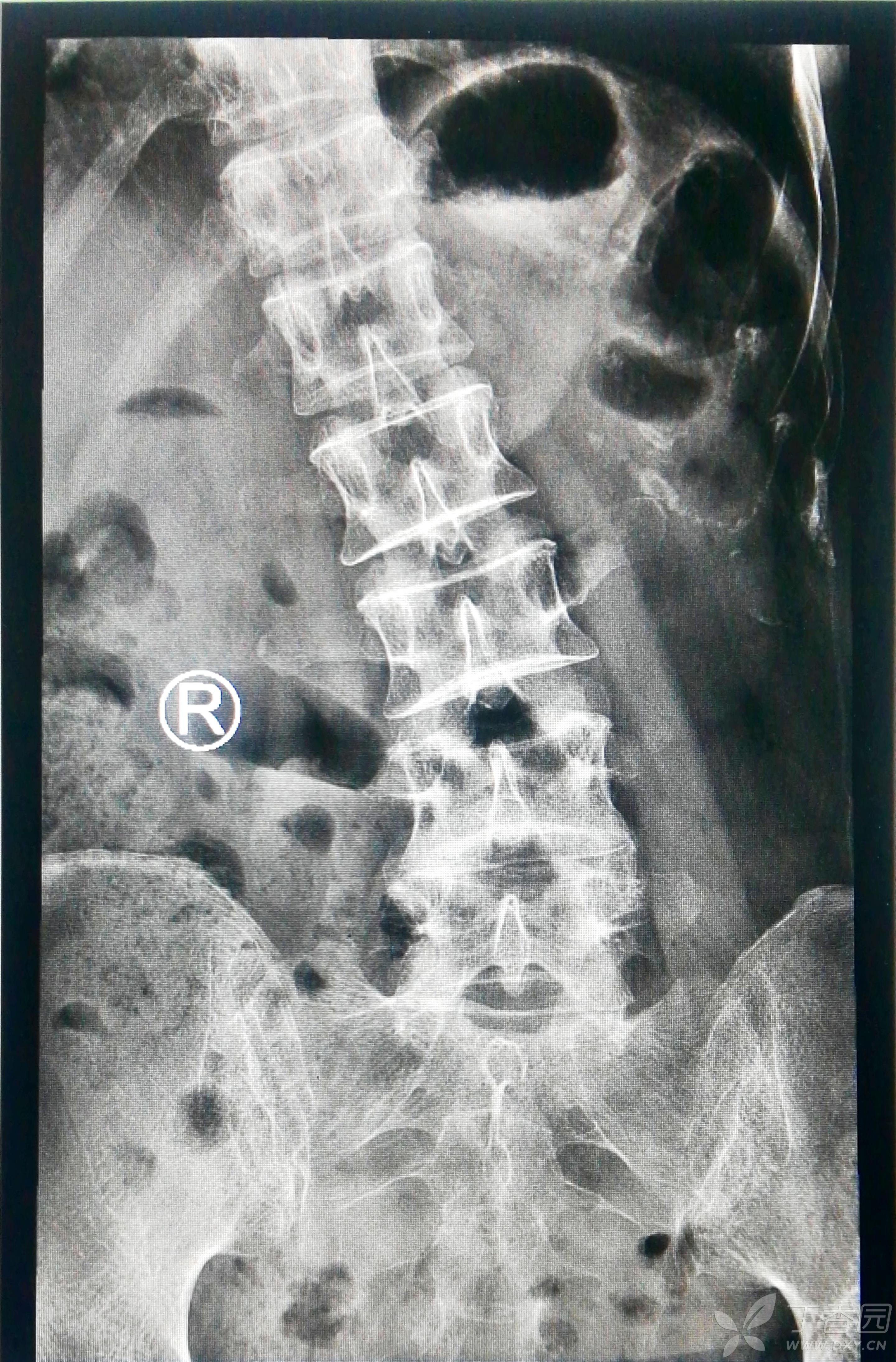 黄骨头孔镜手术日记12——腰4-5椎间盘突出合并终板炎一例(脊柱内镜
