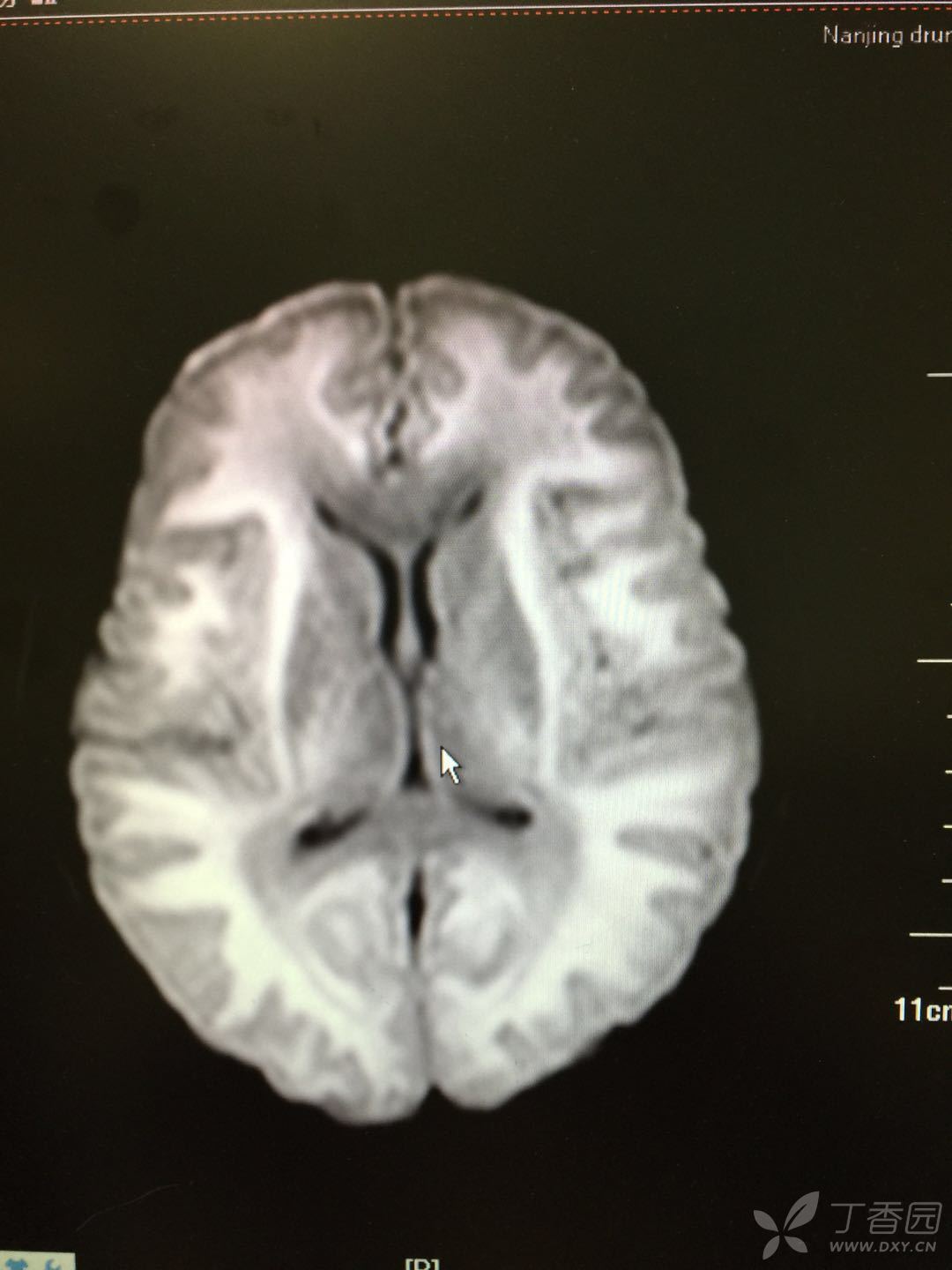 青年男性 如此弥漫性白质病变 诊断考虑什么 神经科学专业讨论版 丁香园论坛